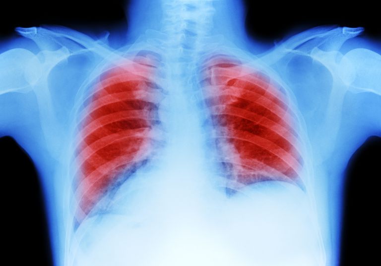 större risk, bakteriell lunginflammation, COPD orsakas, Detta leder, inte ovanligt, obstruktiv lungsjukdom