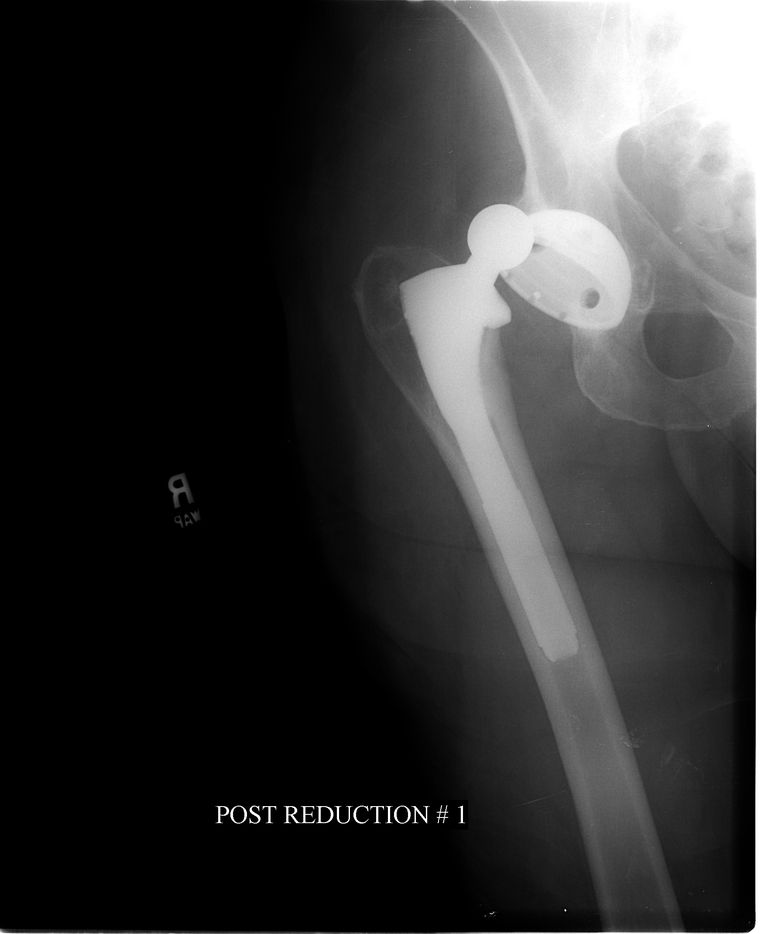 4 Komplikationer av Hip Replacement Surgery