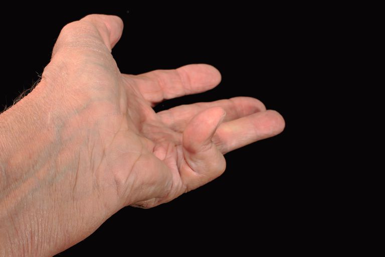 efter behandling, Dupuytrens kontraktur, invasiv behandling, detta tillstånd, drar fingrarna, drar fingrarna handflatan