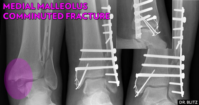 malleolära frakturer, frakturer medialmalleolus, mediala malleolära, frakturen uppträder, frakturer kräver, frakturer kräver kirurgi