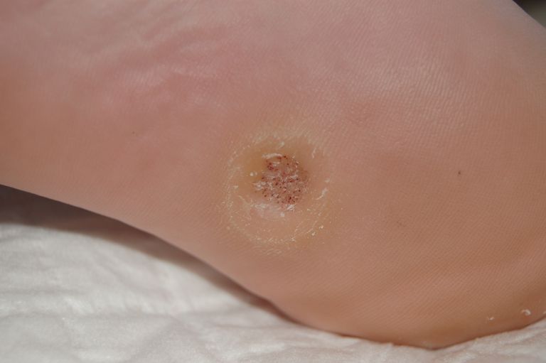 bakteriell infektion, dina fötter, eftersom liknande, majs eller