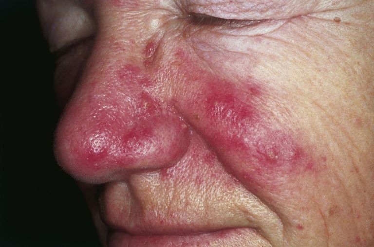 ansiktet särskilt, Keratosis pilaris, orsakar finnar, rätt diagnos