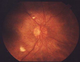 diabetisk retinopati, användas minska, berövad näringsämnen, berövad näringsämnen syre, blir berövad