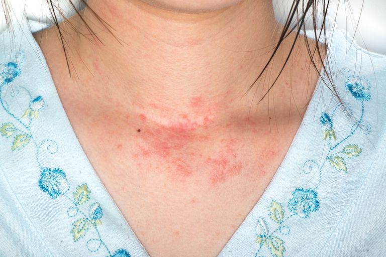 atopisk dermatit, händerna fötterna, huden orsaka, kallad eksem, orsaka klåda