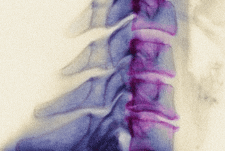 cervikal spondylos, nack artrit, artrit nacken, domningar eller, domningar eller svaghet, eller svaghet