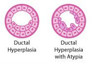 duktal hyperplasi, utveckla bröstcancer, Atypisk duktal, atypisk hyperplasi