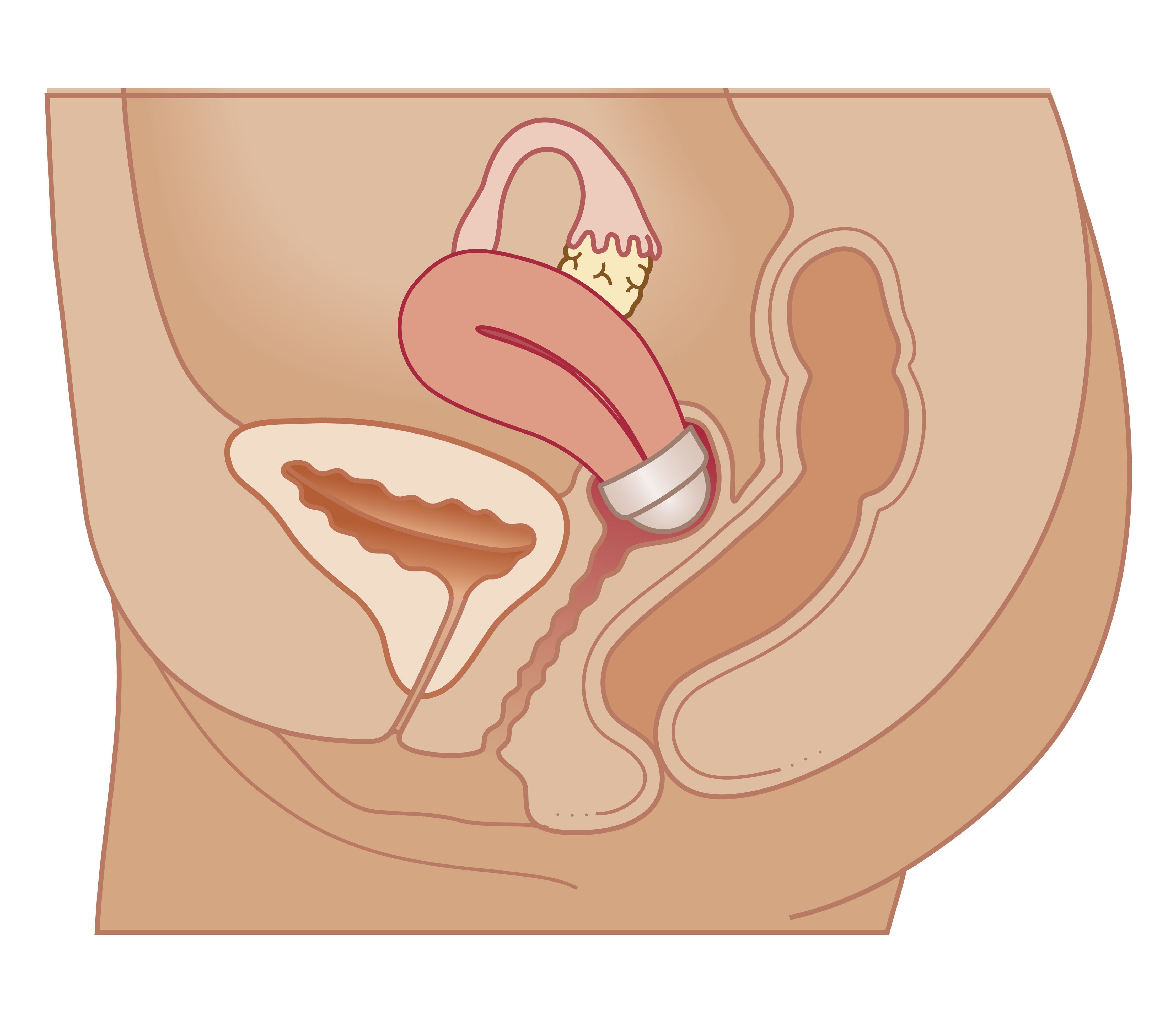 Intrauterine Device, östrogen progestin, blockerar öppningen, Denna metod, Depo Provera, Depo Provera-skottet