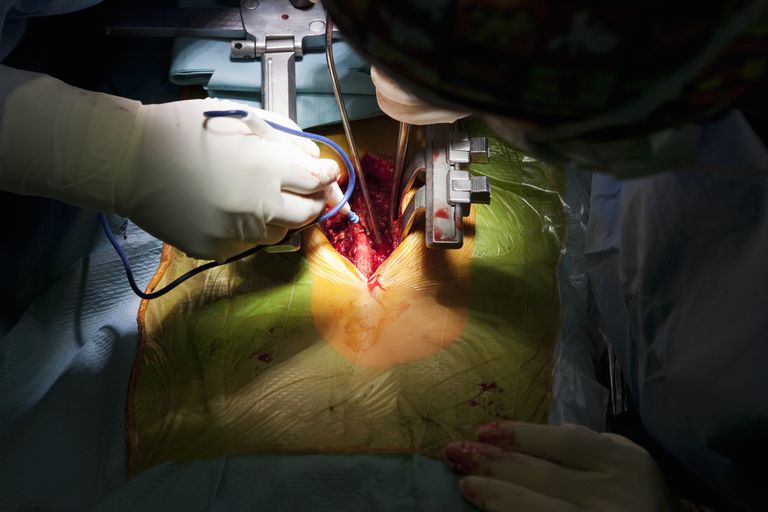 operation ryggen, navigering kirurgiska, postoperativa komplikationer, akademin neurokirurger, amerikanska akademin