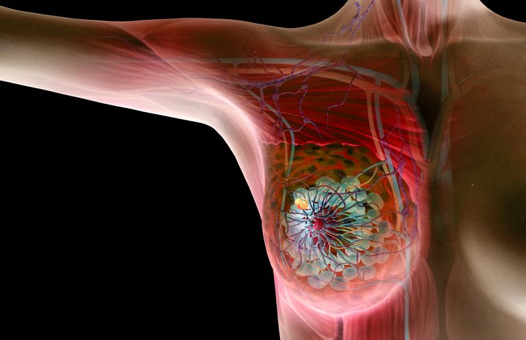 biopsi behövs, eller tumör, godartad eller, utveckla bröstcancer, vara svårt, alla åldrar