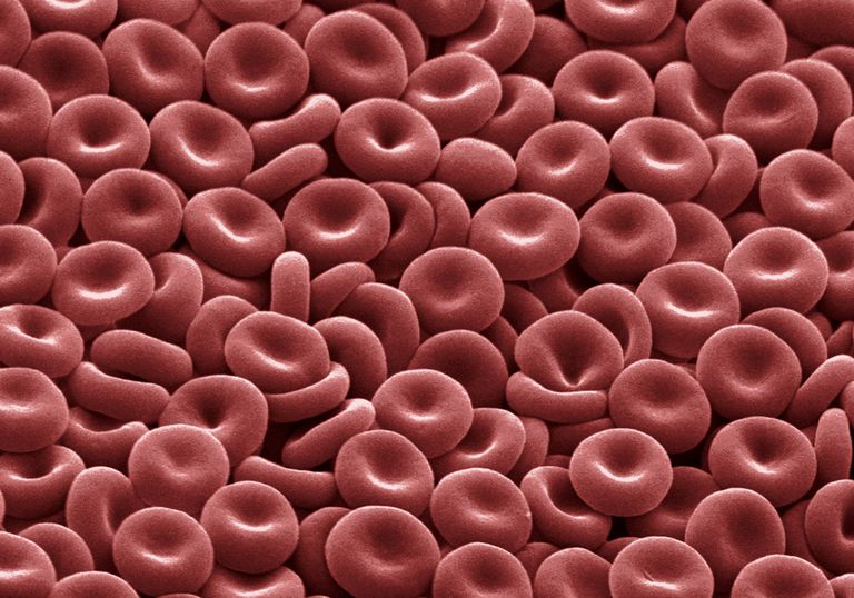röda blodkroppar, orsaka anemi, anemi genom, anemi kronisk, anemi kronisk sjukdom, blodkroppar Detta