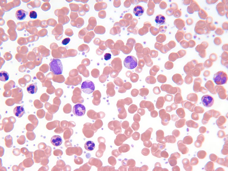 Killer T-celler, vita blodkroppar, amerikanska cancerförbundet, amerikanska cancerförbundet uppskattar