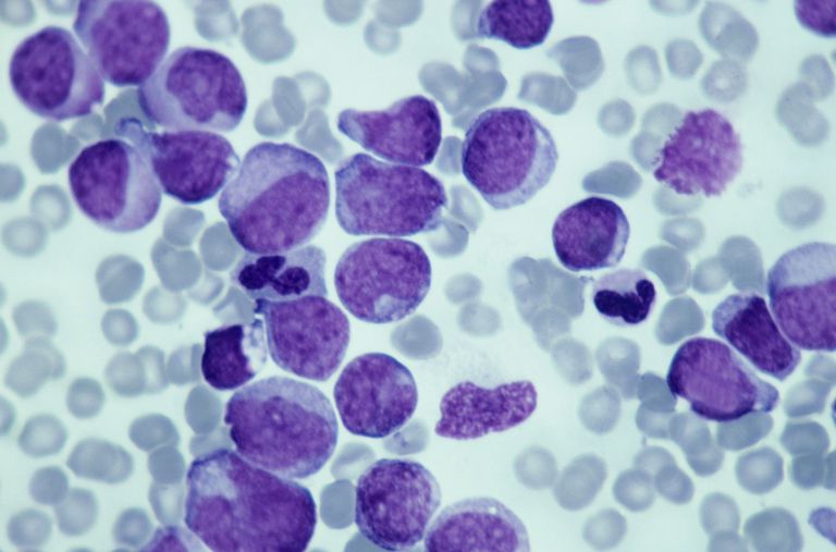 vita blodkroppar, Waldenstroms makroglobulinemi, blodkroppar vita, denna cancer