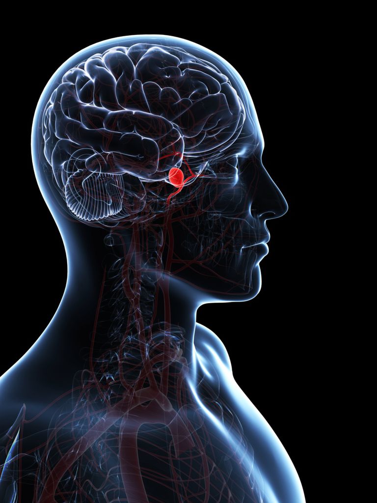 blödning hjärnan, effektiva sätt, effektiva sätt förhindra, eller älskade, hemorragisk stroke