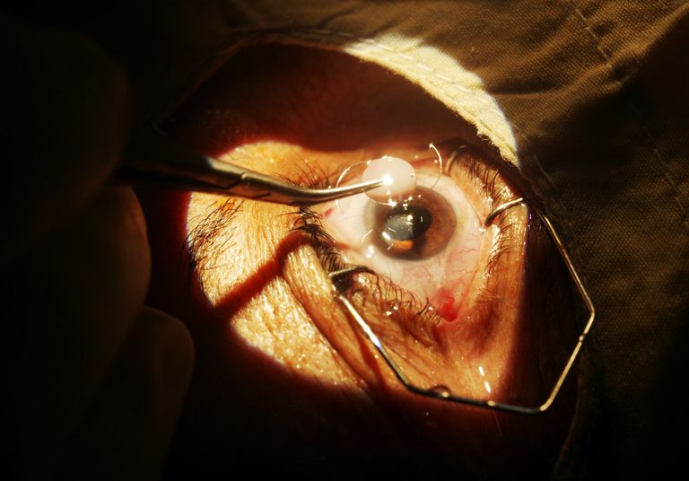 efter operationen, dina ögon, efter kataraktoperation