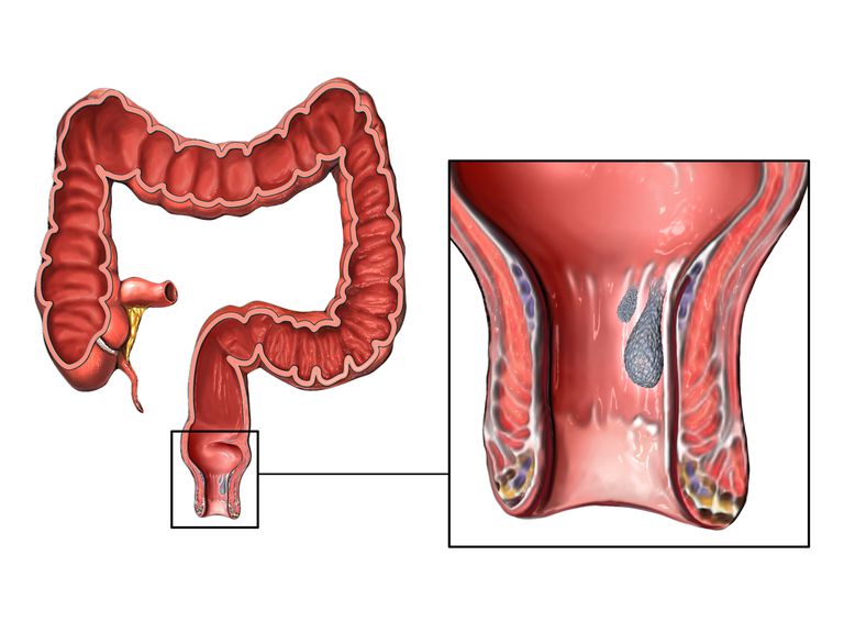 avföring eller, avföring eller toaletten, Blödning från ändtarmen, Crohns sjukdom