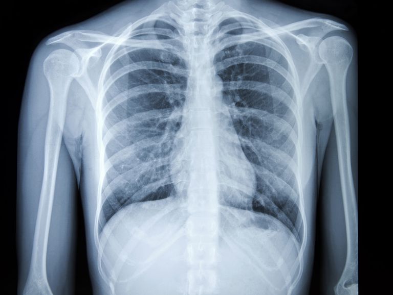diagnos lungcancer, från lungcancer, riskfaktorer lungcancer, symptom lungcancer