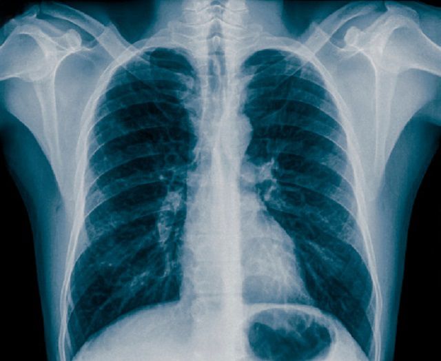 andra tillstånd, dina lungor, hjärta eller, röntgen bröstet