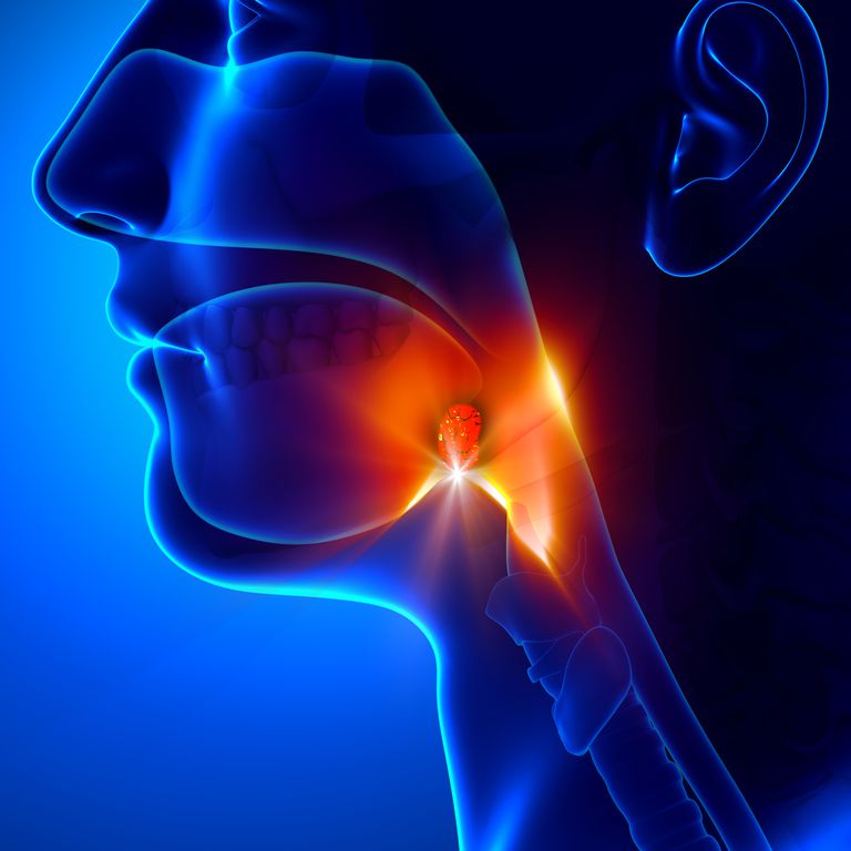 Kronisk tonsillit, återkommande tonsillit, strep hals, tonsillit vanligare