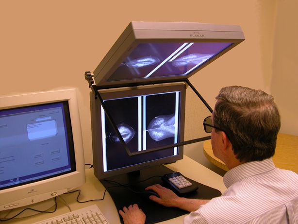 digital mammografi, Cancer Institute, Digital Mammographic, Digital Mammographic Imaging, Imaging Screening