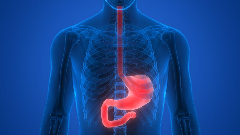 Crohns sjukdom, Crohns sjukdom matstrupen, sjukdom matstrupen, övre endoskopi, matstrupen innefatta