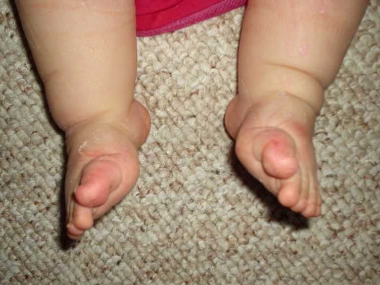 vertikal talus, båda fötterna, ditt barn, ditt barns