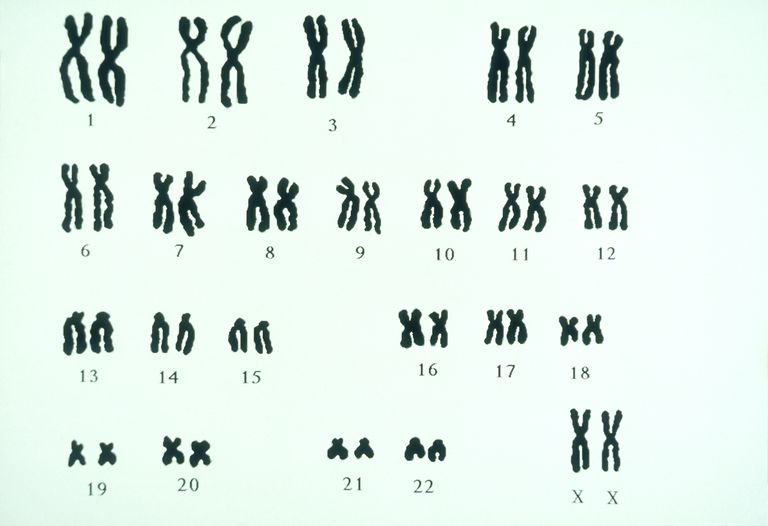 FISH-analys karyotyp, alla kromosomer, Downs syndrom, Eftersom karyotyp, Eftersom karyotyp information, helst från