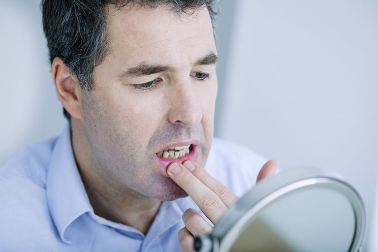 oral infektion, bakteriell endokardit, bakterier munnen, borstning tandtråd, Forskare funnit