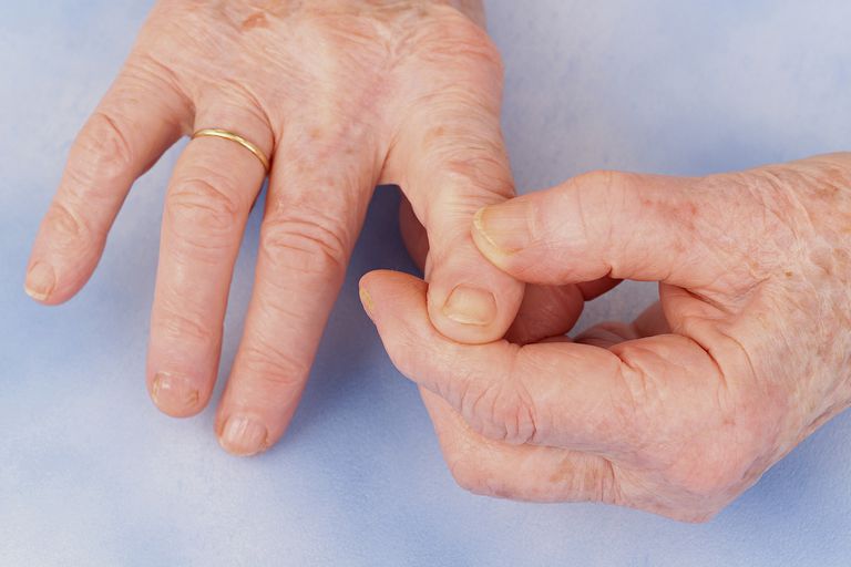 hand artros, behandling osteoartrit, rekommendationer behandling, jämna mellanrum, olika gäller, osteoartrit handen