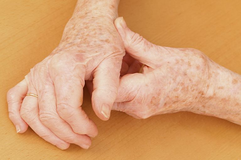 osteoartrit handen, diagnostisera artros, dina symptom, hand artros