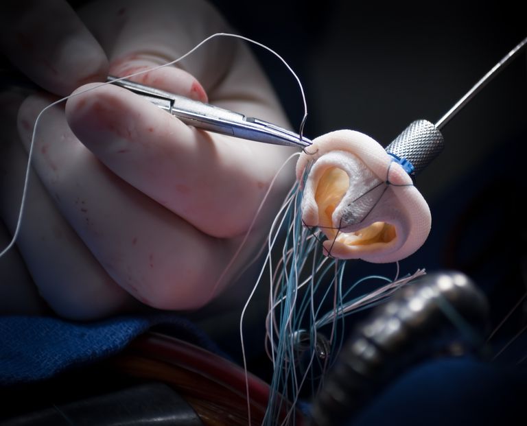 artificiell ventil, återvinns från, biologisk hjärtventil, ersättning biologisk, konstgjord ventil, ytterligare operation ersätta