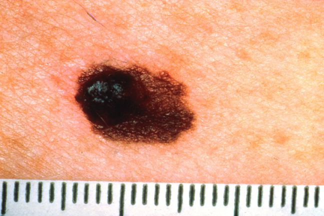 Normal Mole, kontakta läkare, risk utveckla, risk utveckla melanom, utveckla melanom