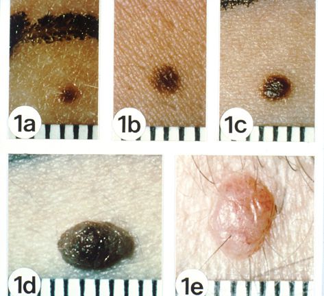 Normal Mole, kontakta läkare, risk utveckla, risk utveckla melanom, utveckla melanom