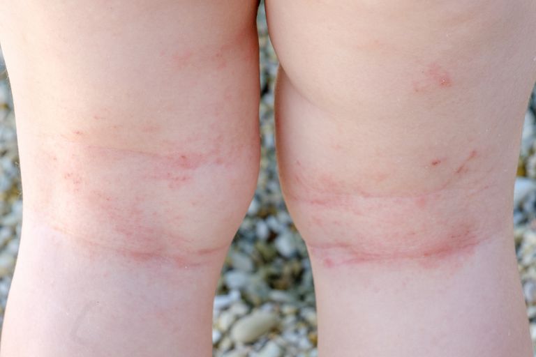 atopisk dermatit, äldre barn