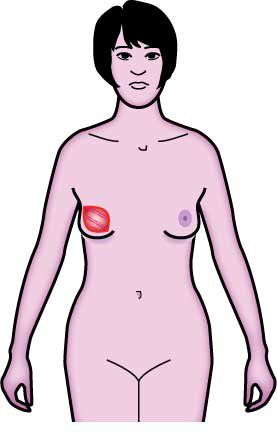nedre skinka, ditt bröst, kommer kirurg, använder vävnad, använder vävnad från
