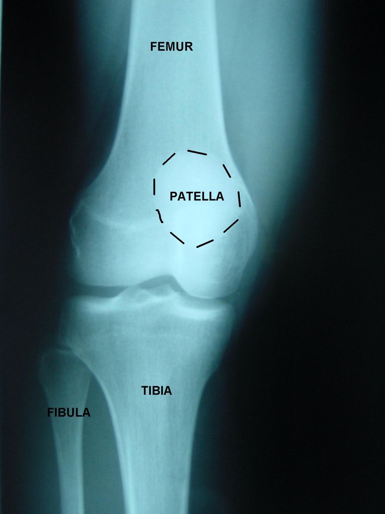 artrit vanligaste, framifrån knäleden, från sidan, kallar segmentet, kallar segmentet mellan, nedre extremiteten