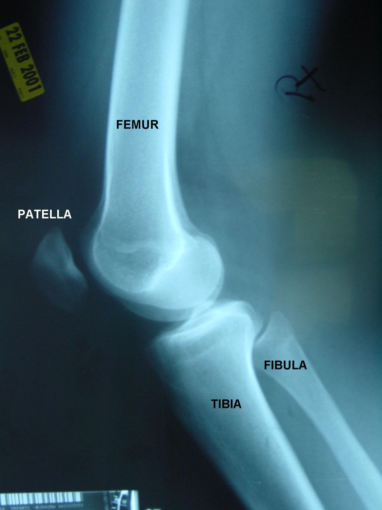 artrit vanligaste, framifrån knäleden, från sidan, kallar segmentet, kallar segmentet mellan, nedre extremiteten