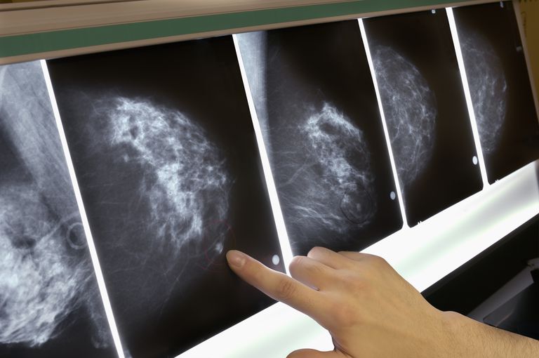 vävnad runt, invasiv bröstcancer, oregelbunden kontur, procent kvinnorna