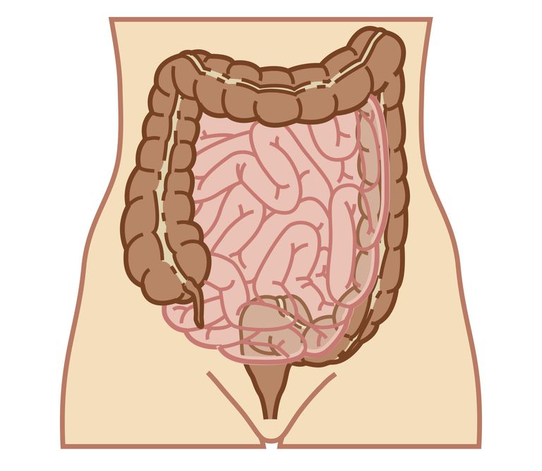 Crohns sjukdom, ulcerös kolit, Crohns sjukdom ulcerös, kolorektal cancer, kräva operation, sjukdom ulcerös