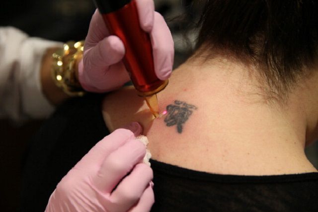 tatuering avlägsnande, andra metoder, laser tatuering, laser tatuering avlägsnande, tattoo borttagning