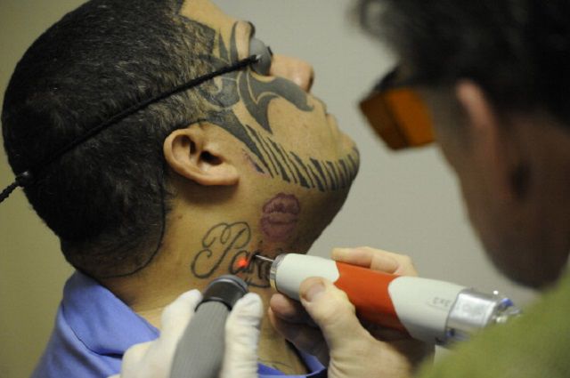 tatuering avlägsnande, andra metoder, laser tatuering, laser tatuering avlägsnande, tattoo borttagning