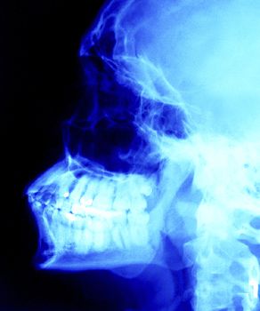 dentala röntgenstrålar, ökad risk, ökad risk sköldkörtelcancer, risk sköldkörtelcancer, behov inte, dentala röntgenstrålar barn
