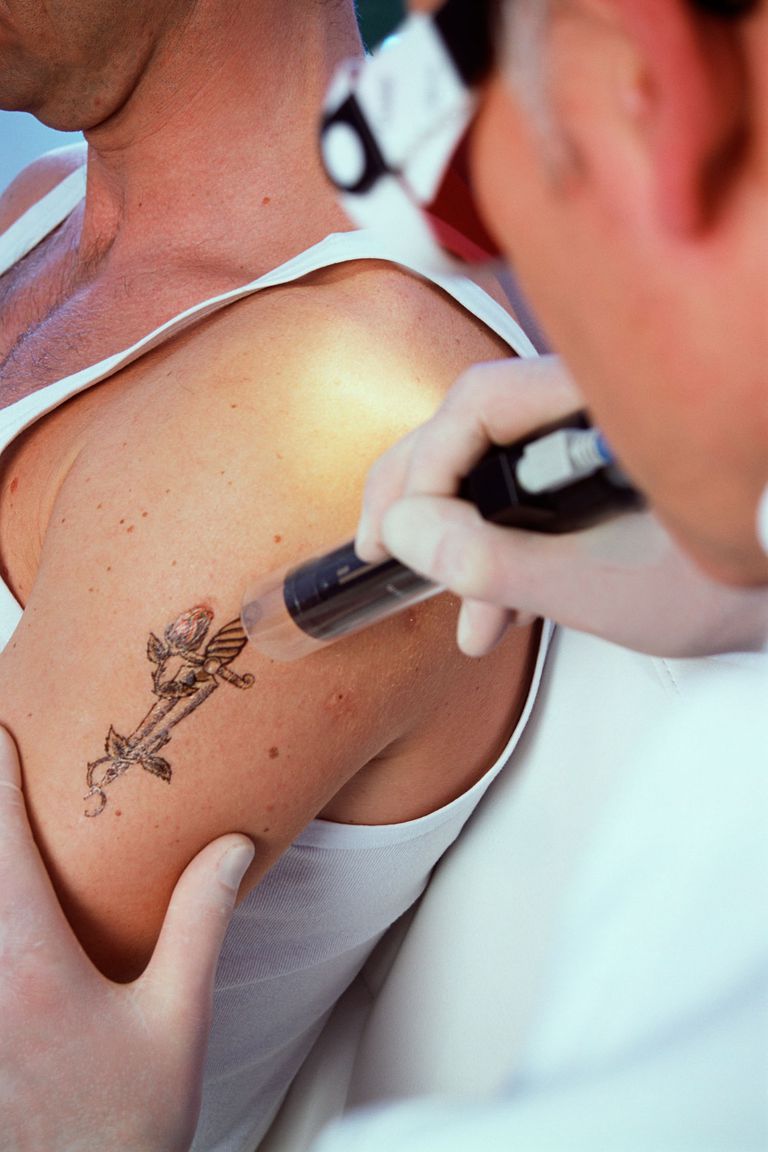 bort tatueringen, Laser Tattoo, Laser Tattoo Removal, Tattoo Removal