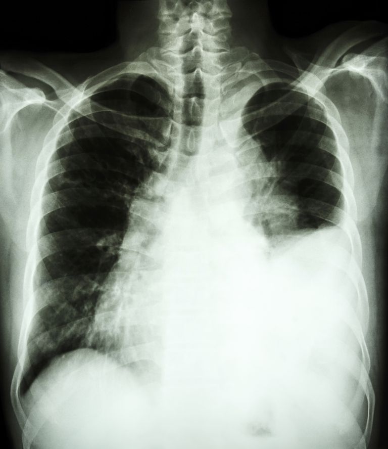 personer lungcancer, pleural effusion, procent personer, anses vara, kalcium från, medicinsk nödsituation