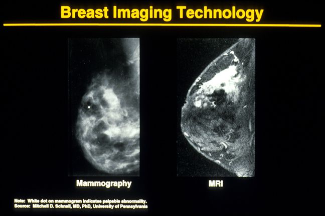 äldre kvinnor, anses vara, bröstvävnad mammogram, dessa bilder