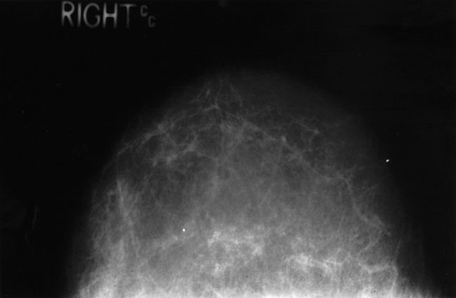 äldre kvinnor, anses vara, bröstvävnad mammogram, dessa bilder