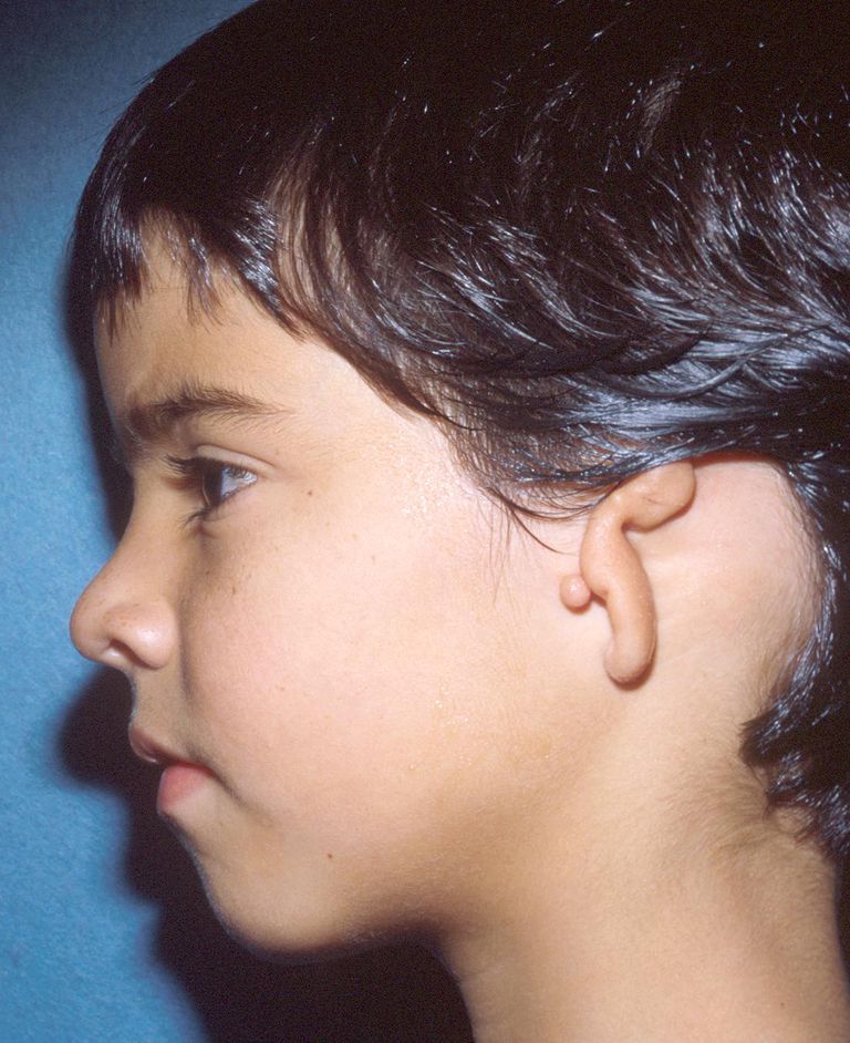 inre örat, barn mikrotia, detta tillstånd, yttre örat