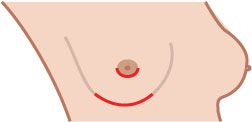 naturliga bröstvårtor, dina naturliga, dina naturliga bröstvårtor, biopsi vävnad, bröstvårtbesparande mastektomi