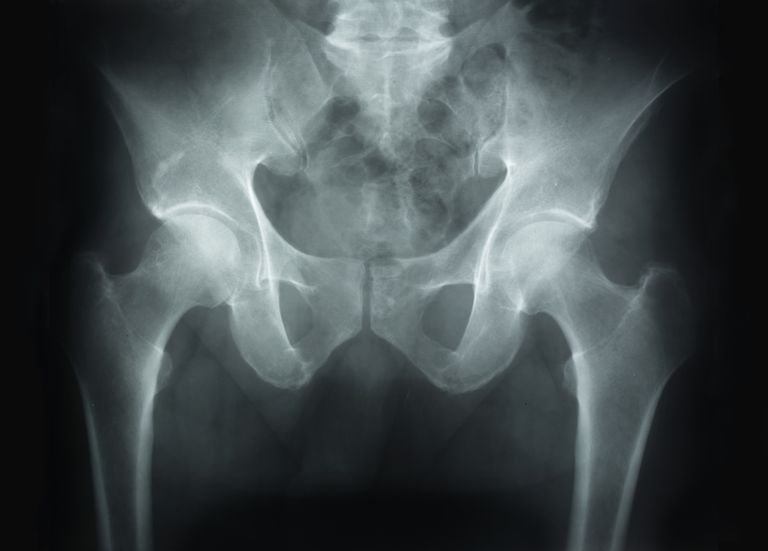 osteonekros utvecklas, anses vara, orsakar osteonekros, stadier osteonekros, tidiga stadier, tidiga stadier osteonekros