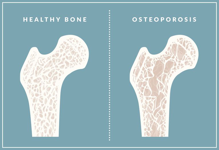 andra behandlingsalternativ, behandling osteoporos, förebyggande behandling, förebyggande behandling osteoporos