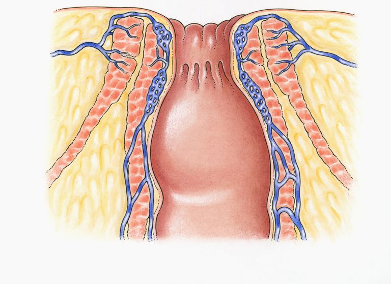 Crohns sjukdom, Anal stenos, avföring från, frisättning avföring